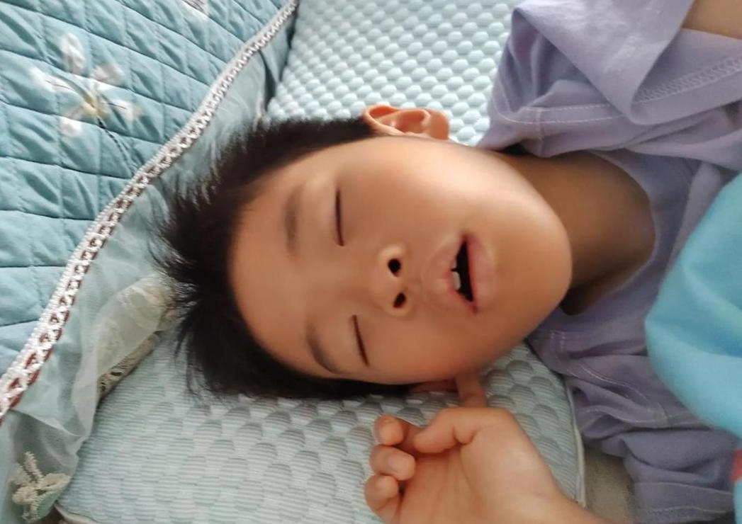 儿童腺样体肥大治疗攻略：手术还是观察？