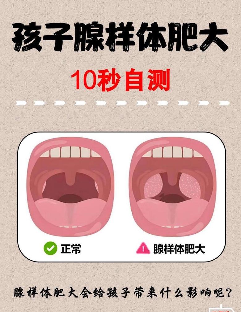 腺体肥大症状及部位科普